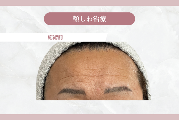 額シワ治療施術前