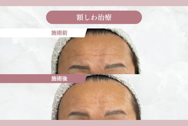 額シワ治療施術後
