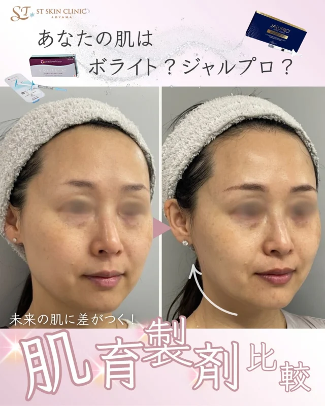 📣【肌育注射】あなたに合うのは、ボライト？ジャルプロ？未来の肌に差がつく、“肌そのものを育てる注入”とは？詳細は続きを読むから↓
@dr_shiori

⁡
肌の乾燥・ハリ不足・小ジワ・ツヤのなさ…
年齢とともに変わっていく肌悩み。

「スキンケアでは届かない、肌の土台から立て直したい」
そんな方に選ばれているのが、
“肌そのものを育てる”肌育注射です✨

🧴《注射で育てるスキンケア》とは？
真皮層に直接アプローチして
コラーゲン・エラスチンの産生を促進。
ハリ・ツヤ・弾力を内側から底上げします。

どの製剤を使うかはもちろん大切。
けれど、それと同じくらい大切なのが
✔️どの層に
✔️どんなバランスで
✔️どう注入するか、という“技術”です。

肌育注射は“打てばいい”ものではなく、
繊細な見立てと注入技術によって、効果に大きな差が出る治療。
だからこそ、症例数や経験値にも注目して選んでみてくださいね。

✳︎ ✳︎ ✳︎

当院で人気の2大肌育注射をご紹介👇

①【ボライト】
高保水型ヒアルロン酸で、
うるおい＆ツヤ感をしっかりチャージ💧
・乾燥・ごわつき
・毛穴の開き
・化粧ノリ不足が気になる方におすすめ

✔️効果：注入後1ヶ月ほどで実感
✔️持続：6〜9ヶ月

②【ジャルプロ スーパーハイドロ】
ヒアルロン酸＋アミノ酸＋ペプチドで
肌の内側からコラーゲン生成を強力にサポート！
肌の構造を立て直し、ふっくらとしたハリ肌へ導きます。

・ちりめんジワ
・ハリ・弾力低下
・頬やあごまわりの“ゆるみ”や、なんとなく老けた印象が気になってきた方におすすめ

✔️効果：3回程度の継続注入でしっかり実感

✳︎ ✳︎ ✳︎

どちらの肌育注射も、季節を問わず一年中受けられるのが魅力。
特に紫外線や乾燥の影響を受ける前にケアしておくことで、
お肌が揺らぎにくくなり、自然なハリやツヤが育ちやすくなります🌿

💬カウンセリングでは、私が実際にお肌の状態を拝見して
今のあなたにいちばん合う方法をご提案しています。

「今の肌を、未来の自信に変えたい」
そんな方に届けたい、美容医療です。

= = = = = = = = = = = = = = = = = = = = = = = = = = =

📌 “今じゃないかも”と思っても、大丈夫。
気になったら保存をタップ👆いつかの参考にしてくださいね🫧

📩 ご相談・ご予約はプロフィールの公式LINEからどうぞ。
💬 ご質問やコメントもお気軽にお寄せくださいね。

= = = = = = = = = = = = = = = = = = = = = = = = = = =

💉ご予約は公式LINEより承っております
プロフィールのリンク🔗をTAP
→ 公式LINEからご予約いただけます

.............................
🏥STスキンクリニック青山
〒107-0061 東京都港区北青山２丁目９−１４
外苑前駅『3番 出口』より徒歩1分
🕐営業時間:10-18時（詳細はInstagramにて）
🌼休診日：不定期
.............................
#STスキンクリニック青山
#しぃちゃん先生
#肌育注射
#肌育製剤
#自然に綺麗になりたい
#美容医療初心者さん歓迎
#ボライト
#ジャルプロスーパーハイドロ
#ちょっと前向きになれる美容医療